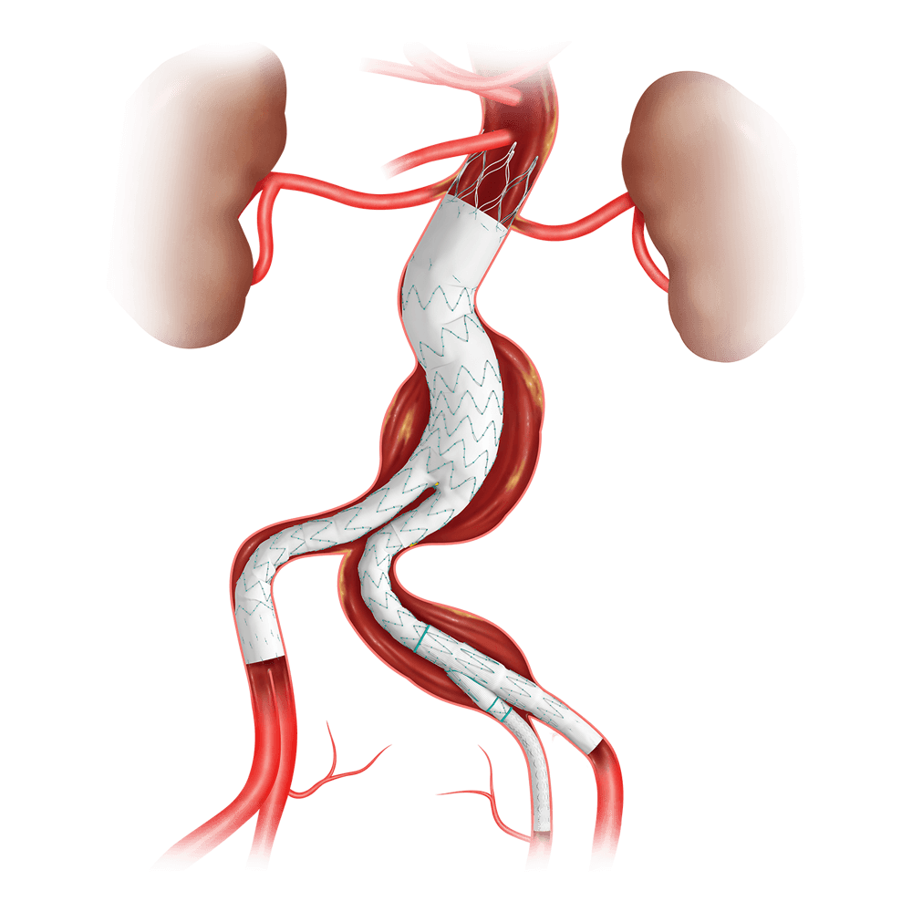 Zenith Alpha™ Abdominal Endovascular Graft Bifurcated Main Body Graft