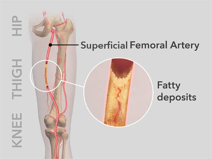 Causes and risks of PAD