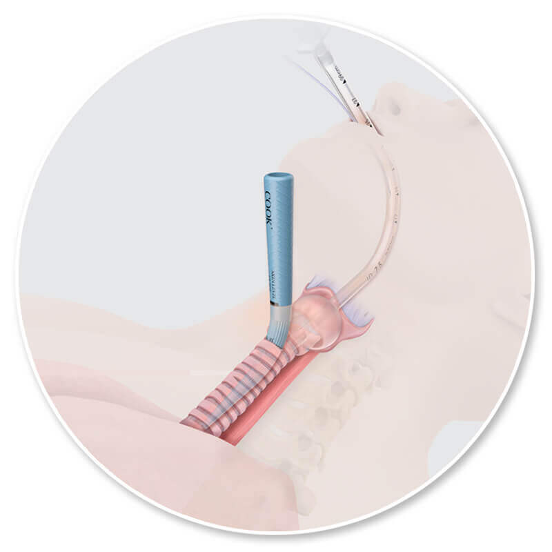 The benefits of percutaneous tracheostomy